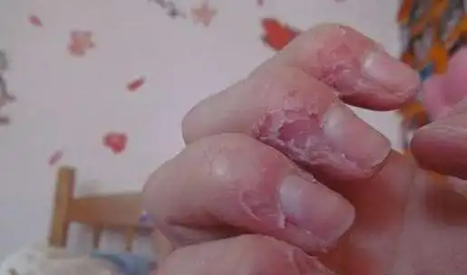 咬手指成瘾是强迫症,后果比你想的还严重!