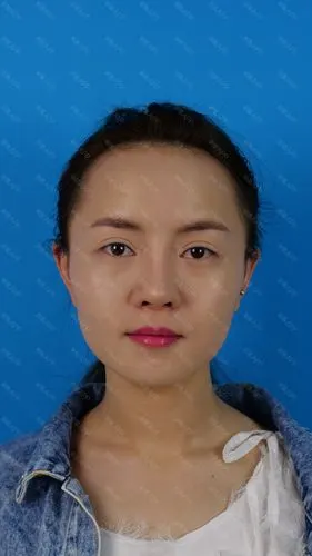 严重肿胀期自体脂肪全脸填充第0天 · 第1篇日记