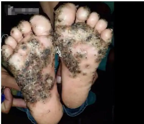 恐怖10岁女孩光脚在猪圈玩脚底感染寄生虫在皮肤上挖洞