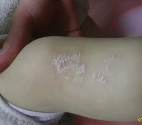 银屑病治疗时有什么要注意-贵州白癜风皮肤病医院银屑病科