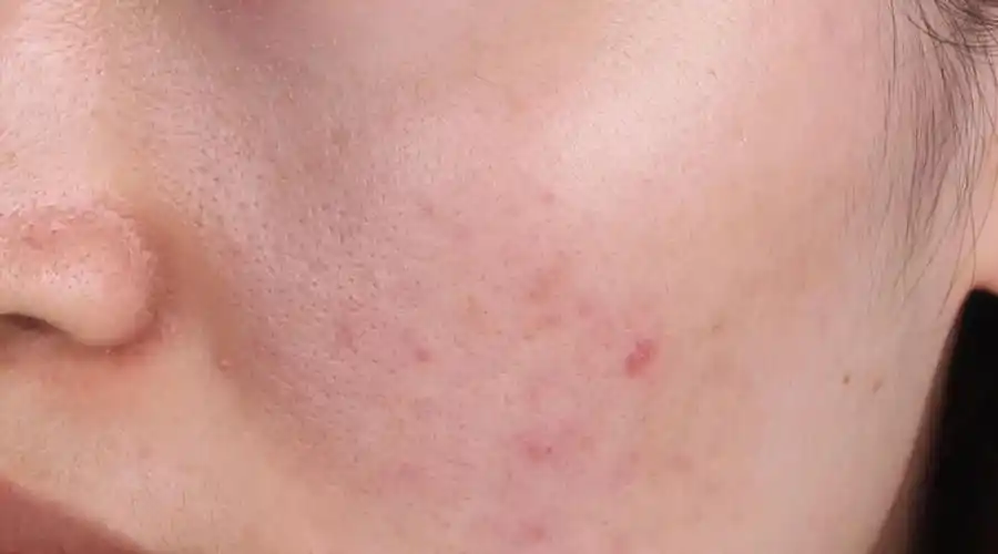 什么是屏障受损型毛孔粗大?该如何治疗?-周先勇主治医师-爱问医生