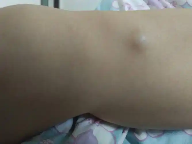 我老婆腿上长了一个这样的东西,大概一年多了平时不