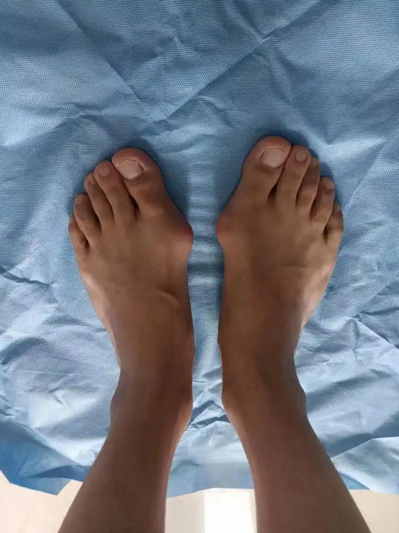 双足#拇外翻# 拇外翻,32岁男性,经皮克氏针固定,免去内固定烦恼!