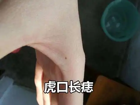 男女人左手虎口有痣好吗