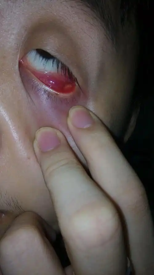 一个诊所说是不干净!今天这个说是上火引起!有医院的网友知道这是啥不