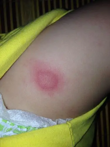 宝宝九个月了,开始看着像蚊子疙瘩,然后开始肿起来,摸着硬硬的,面上