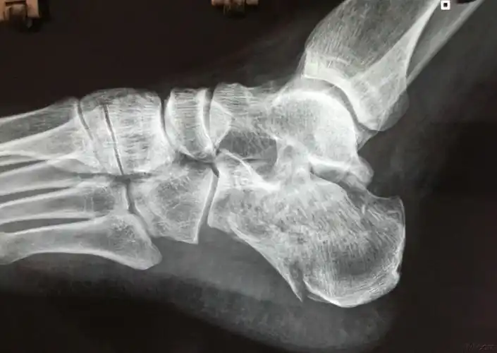 右侧跟骨粉碎骨折