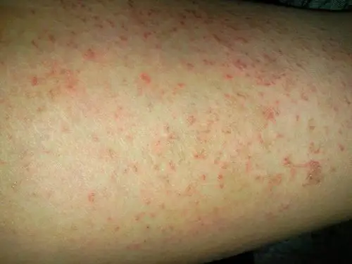 2011-04-07 21:27提问者采纳 你好,根据图片看起来像是过敏性皮炎