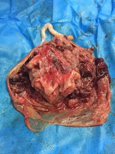 一例凶险性前置胎盘状态的完美收官