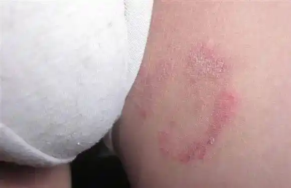 皮肤病微课堂真菌性皮肤病股癣