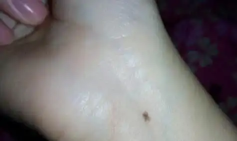 女人左手腕有痣图解 女人左手腕有痣图解大全