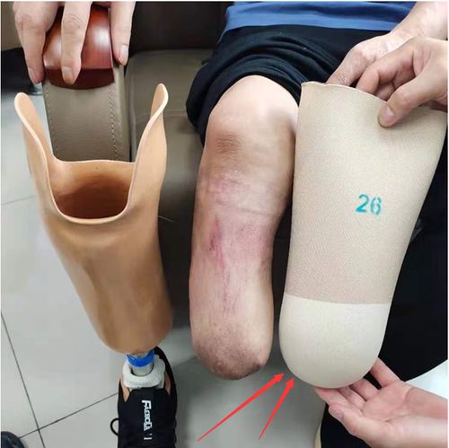 假肢大腿假肢套 硅胶套凝胶套 大腿套 小腿套 20