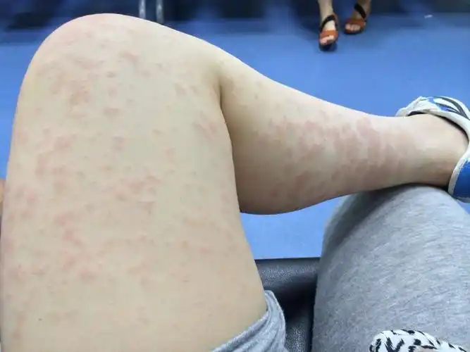 我得了过敏性皮炎停了5天母乳,连续打了5天的复方甘草酸苷和门冬氨酸