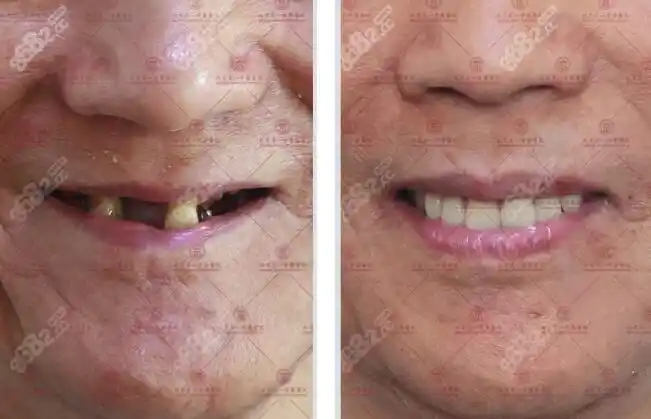 种植牙收费价格是多少?