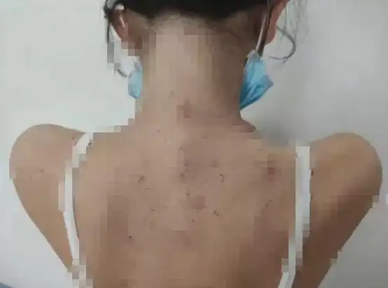 12岁女孩患"不死的癌症",每天抠到流血!这种病极易与湿疹混淆|皮炎|瘙