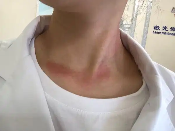 脖子过敏红痒,是怎么回事要怎么处理?