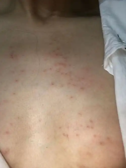 孕妇身上出现这种红色的斑点是怎么回事?还特别痒