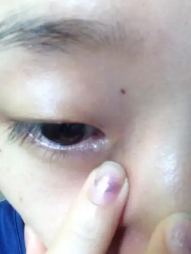 眼角长了个白色小疙瘩时间挺长了但是一