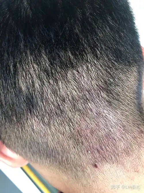 头部毛囊炎 三年了反复多次? - 知乎