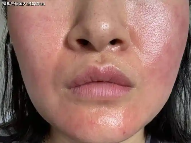 皮肤屏障受损,如何有效修复?