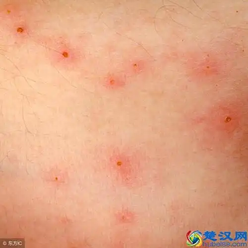 脸上过敏性皮炎怎么办?危害很大,重在预防