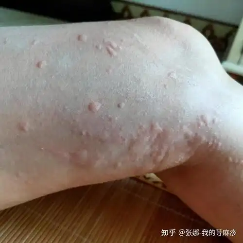 荨麻疹这类过敏性皮肤病的病因难道不是免疫力强吗为什么医生还会建议