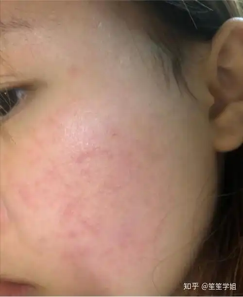 油皮敏感肌求推荐日本日系平民护肤品