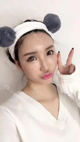 自体脂肪填充全脸