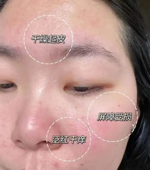 敏感肌肤怎么办