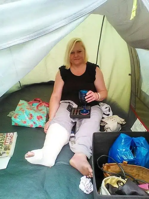 女子刮腿毛刮到整条右腿溃烂 最后发展到整条右腿截肢