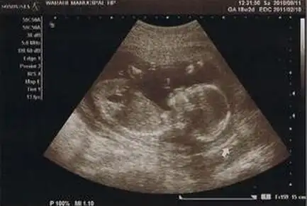 怀孕18周有胎动吗孕18周胎儿发育情况和注意事项