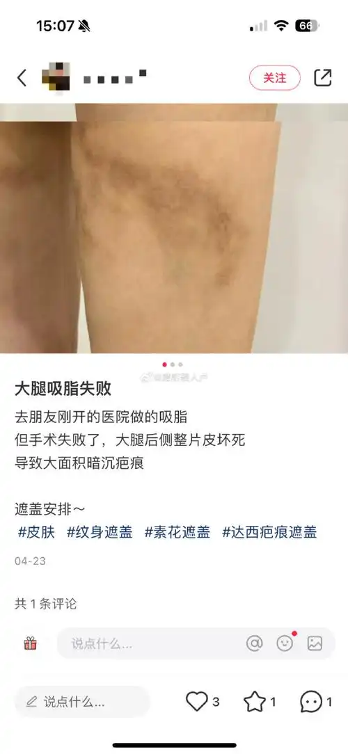 吸脂走过的弯路#大腿吸脂失败皮肤坏死,划重点7199"朋友"(可能是