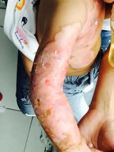 被油烫伤怎么处理