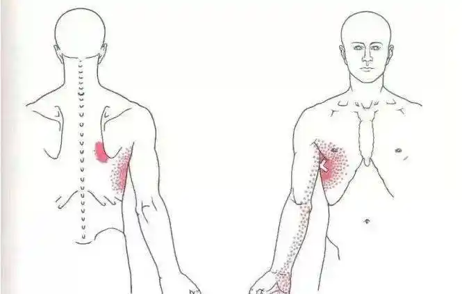 肩胛骨内侧缘疼痛可能是这十块肌肉劳损了