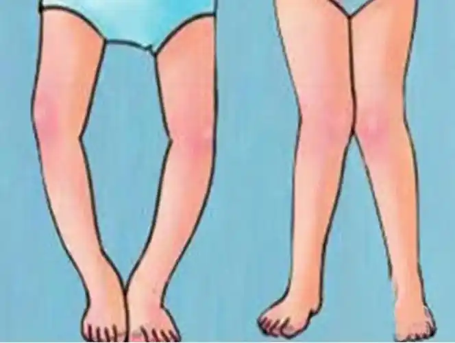 内八字,外八字孩子脚型正常不正常,家长可以这么判断