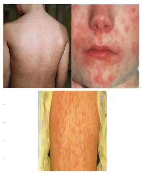 麻疹科普小知识