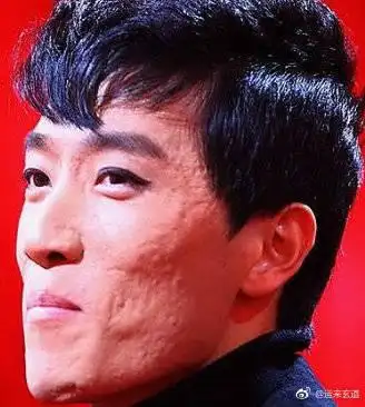 所谓的橘皮面,指的就是脸部坑坑洼洼,如月球表面,多见于男性,如陈羽凡