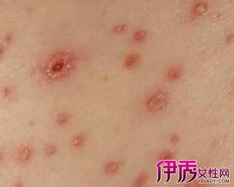 【图】艾滋病初期症状图片女 揭秘艾滋病六大症状