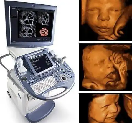 唐氏儿在四维下的特征是什么自己能不能感觉到胎儿的不正常