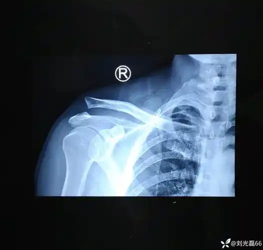 陈旧性肩锁关节脱位