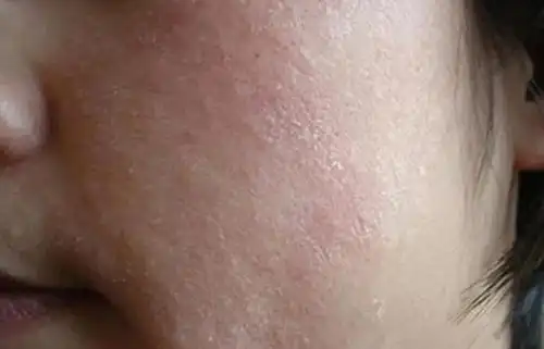 秋冬换季,皮肤瘙痒起皮潮红,你该这么护理!_肌肤