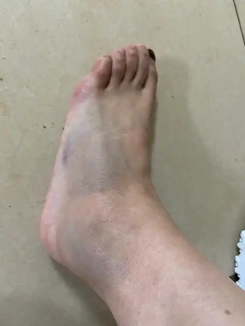 骨折记 — 第五跖骨基底骨折 - 知乎