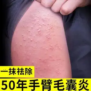 手臂毛囊炎专用痘痘疙瘩脓包痤疮瘙痒药膏真菌感染外用冷敷凝胶sj