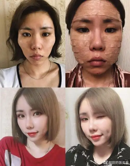 自体脂肪填充有什么风险?面部填充后脸会变大?