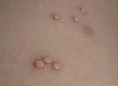 痒痒痒得了疥疮怎么办