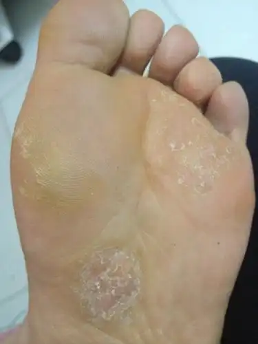 三四年了,不知道是什么情况,脚底老发痒