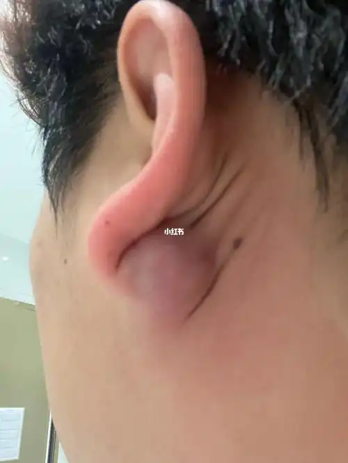7515耳后囊肿!