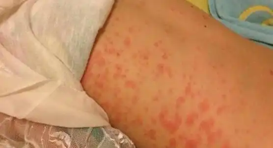 孩子吃多没好处,再馋也要少吃|菠萝|榴莲|芒果|荔枝|过敏_网易订阅