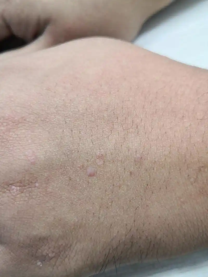 手背扁平疣症状#扁平疣##病毒