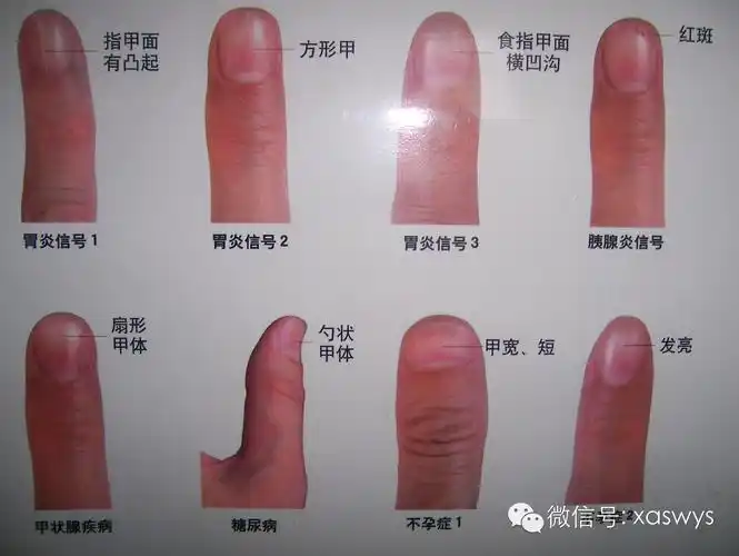 通过望手指甲就能诊断出疾病-指甲诊病法